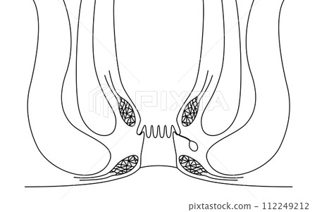 Anal disease, hemorrhoids "Anal hemorrhoids" Illustrated illustration, cross-sectional view 112249212