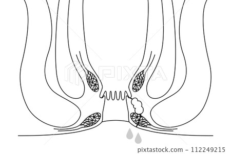 肛門疾病,痔瘡「肛門痔瘡」插圖,橫斷面圖 肛門疾病,痔瘡「肛門痔瘡」插圖,橫斷面圖 112249215