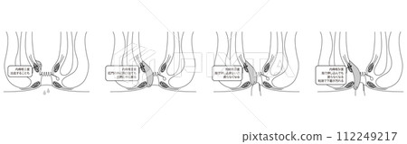 肛門疾病、痔瘡/疣痔「內痔 I 至 IV 級」插圖,橫斷面圖 肛門疾病、痔瘡/疣痔「內痔 I 至 IV 級」插圖,橫斷面圖 112249217