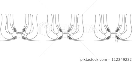 肛門疾病,痔瘡「肛門痔瘡」插圖,橫斷面圖 肛門疾病,痔瘡「肛門痔瘡」插圖,橫斷面圖 112249222