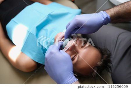 Woman with dental cast veneer on upper jaw in dentistry 112256009