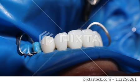 Installation of veneers and dental implants in clinic closeup Installation of veneers and dental implants in clinic closeup 112256261