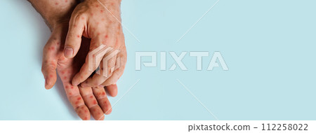 Human Hands with Painful Rash, Red Spots Blisters on the Skin. Health Problem. Monkeypox Disease Symptoms. Male Patient Arms with Monkey Pox. Close Up. Banner, Copy Space. Dengue Fever Infection, MPOX 112258022