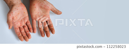 Human Hands with Painful Rash, Red Spots Blisters on the Skin. Health Problem. Monkeypox Disease Symptoms. Male Patient Arms with Monkey Pox. Close Up. Banner, Copy Space. Dengue Fever Infection, MPOX 112258023