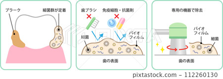 Tooth biofilm removal 112260130