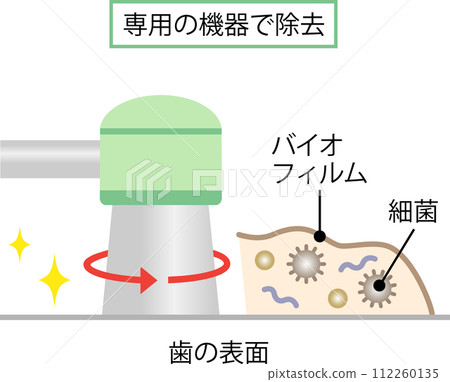 去除牙齒生物膜 去除牙齒生物膜 112260135