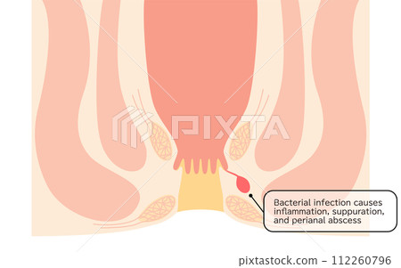 Anal disease, hemorrhoids "Anal hemorrhoids" Illustrated illustration, cross-sectional view Anal disease, hemorrhoids "Anal hemorrhoids" Illustrated illustration, cross-sectional view 112260796