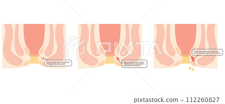 Anal disease, hemorrhoids "Anal hemorrhoids" Illustrated illustration, cross-sectional view Anal disease, hemorrhoids "Anal hemorrhoids" Illustrated illustration, cross-sectional view 112260827