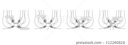 Anal disease, hemorrhoids/wart hemorrhoids "internal hemorrhoids grade I to IV" Illustrated illustration, cross-sectional view 112260828