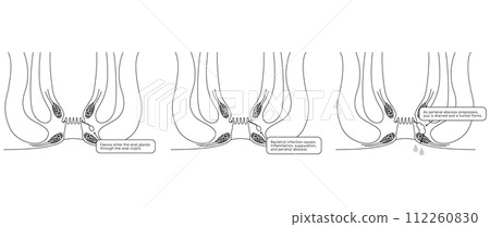 Anal disease, hemorrhoids "Anal hemorrhoids" Illustrated illustration, cross-sectional view 112260830