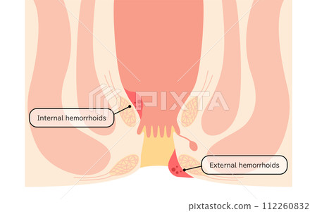 Anal disease, hemorrhoids/wart hemorrhoids illustrated illustrations, cross-sectional view 112260832