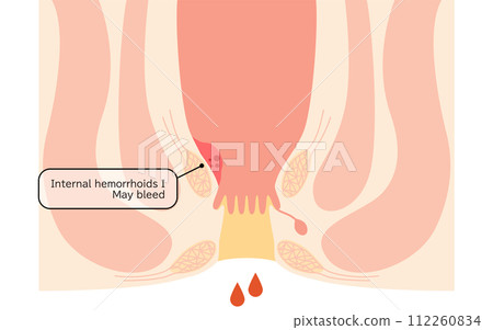 Anal disease, hemorrhoids/wart hemorrhoids "internal hemorrhoids grade I" Illustrated illustration, cross-sectional view 112260834