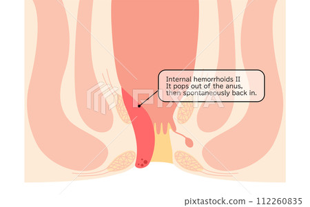 肛門疾病、痔瘡/疣痔「II 級內痔」插圖，橫斷面圖 112260835