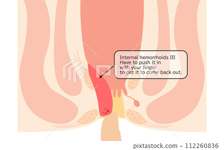 肛門疾病、痔瘡/疣痔「內痔 III 級」插圖，橫斷面圖 112260836