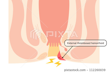 肛門疾病、痔瘡/疣痔「血栓性外痔」插圖，橫斷面圖 112260839