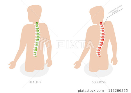 3D Isometric Flat Conceptual Illustration of Scoliosis, Normal Spine and One with Defects 3D Isometric Flat Conceptual Illustration of Scoliosis, Normal Spine and One with Defects 112266255