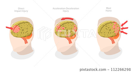 3D Isometric Flat  Conceptual Illustration of Brain Injuries, Head Trauma Scheme 112266298