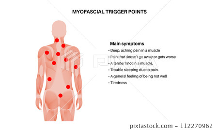 Myofascial trigger points Myofascial trigger points 112270962