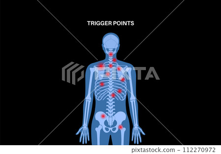Myofascial trigger points Myofascial trigger points 112270972