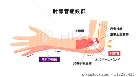 肘管綜合症向量圖的病因及機制 肘管綜合症向量圖的病因及機制 112283425
