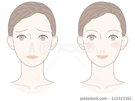 Open pores Strawberry nose improvement female illustration 112323161