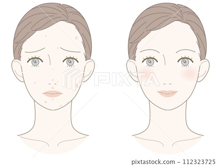 白色痘痘改善女性插畫 白色痘痘改善女性插畫 112323725