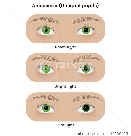 Realistic human eyes with anisocoria vector illustration design. Unequal pupil, anatomy, health. 112330415