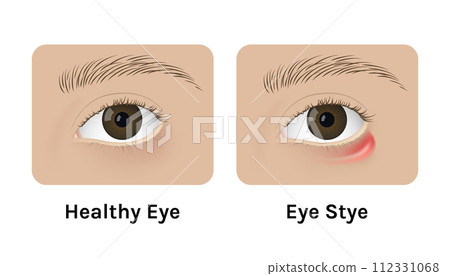 Realistic human healthy eye and with stye vector illustration design. Red inflammation, anatomy, health. Realistic human healthy eye and with stye vector illustration design. Red inflammation, anatomy, health. 112331068