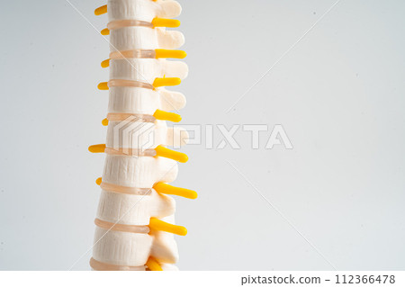 Lumbar spine displaced herniated disc fragment, spinal nerve and bone. Model for treatment medical in the orthopedic department. 112366478