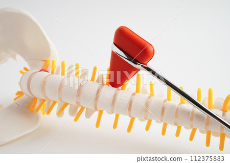 Spinal nerve and bone with knee reflex hammer, Lumbar spine displaced herniated disc fragment, Model for treatment medical in the orthopedic department. Spinal nerve and bone with knee reflex hammer, Lumbar spine displaced herniated disc fragment, Model for treatment medical in the orthopedic department. 112375883
