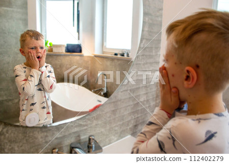 Natural vaccination. Contagious disease. Sick child with chickenpox. Varicella virus or Chickenpox bubble rash on child body and face. High quality photo 112402279