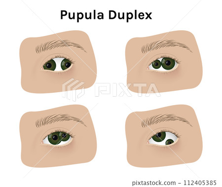 Realistic human eyes with pupula duplex vector illustration design. Human mutation, anatomy, health. 112405385