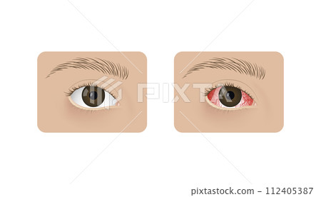 Realistic human healthy eye and with conjunctivitis vector illustration design. Red dry eye syndrome, anatomy, health and allergies. 112405387