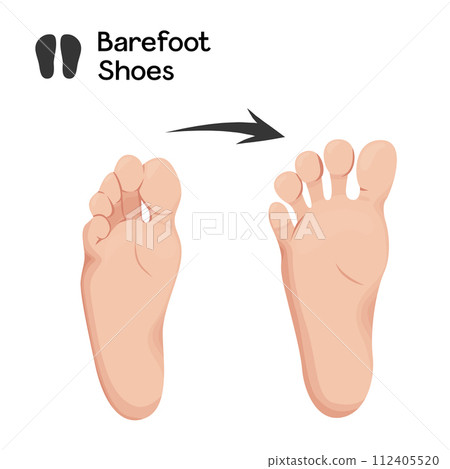 Barefoot shoes care vector illustration. Orthopedic and anatomical shoes. compare healthy and deformity feet. 112405520