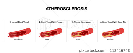 Medical illustration of blood vessel flow and arteriosclerosis 112416748