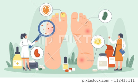 Podiatry concept. Nail and foot disease, medical treatment. Tiny doctors or scientists looking on feet with problems, snugly diagnosis vector scene 112435111