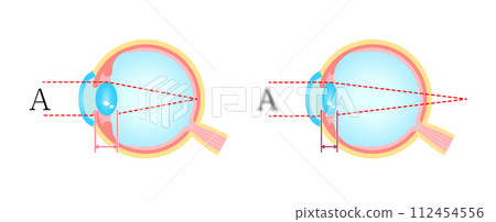 Normal eye and presbyopia comparison vector illustration 112454556