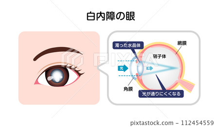 Cataract eye structure and causes vector illustration 112454559