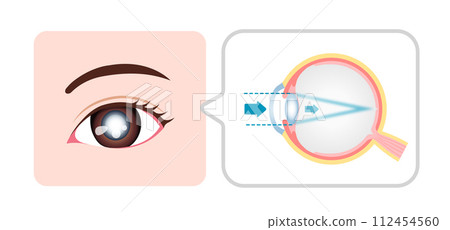 Cataract eye structure and causes vector illustration 112454560
