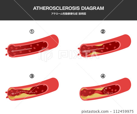 Medical illustration of blood vessel flow and arteriosclerosis Medical illustration of blood vessel flow and arteriosclerosis 112459975