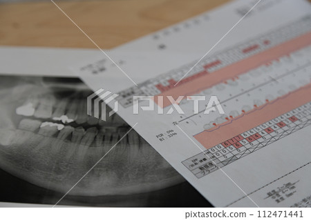 牙醫拍攝的X光照片和牙周病測試表 牙醫拍攝的X光照片和牙周病測試表 112471441