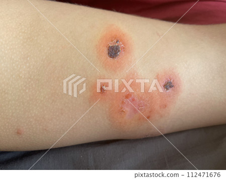 Human shin leg closeup. Body with skin problem. Infectious disease. Human shin leg closeup. Body with skin problem. Infectious disease. 112471676