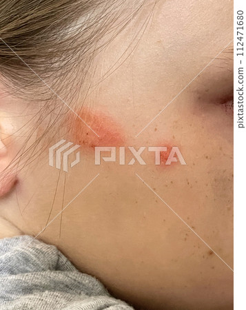 Human face closeup. Body with skin problem. Infectious disease.  112471680