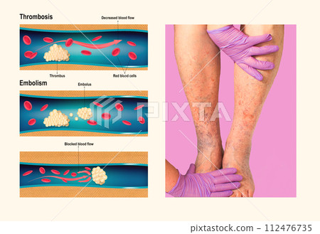 Deep Vein Thrombosis or Blood Clots. Embolus. 112476735