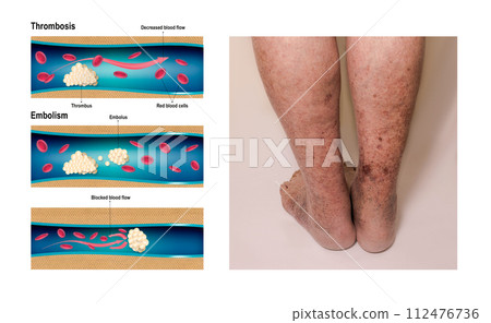 Deep Vein Thrombosis or Blood Clots. Embolus. 112476736
