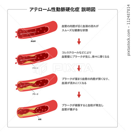 Medical illustration of blood vessel flow and arteriosclerosis Medical illustration of blood vessel flow and arteriosclerosis 112487814