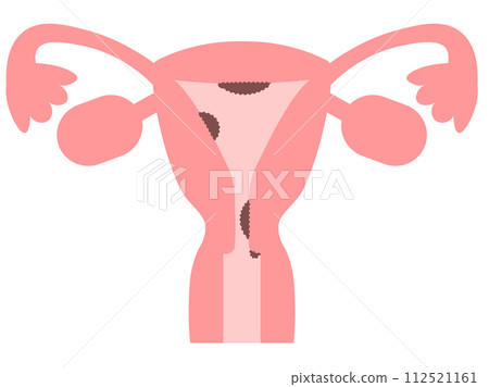輕輕觸摸描繪子宮癌類型的圖像圖 112521161