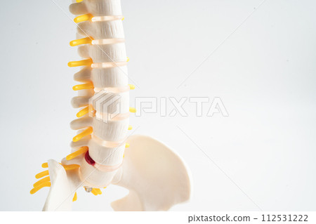 Lumbar spine displaced herniated disc fragment, spinal nerve and bone. Model with copy space for treatment medical in the orthopedic department. 112531222