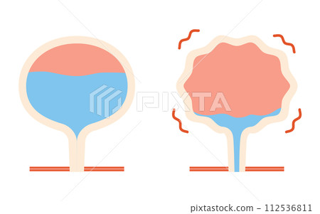 Medical illustration of overactive bladder, comparison between normal bladder and overactive bladder 112536811