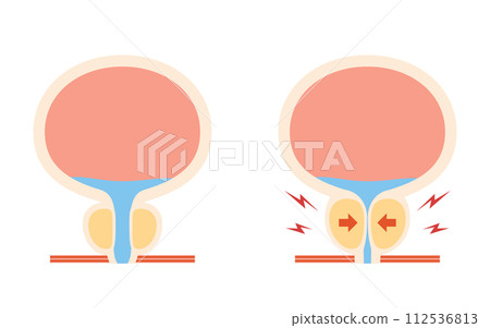 Medical illustration of benign prostatic hyperplasia, comparison of normal prostate and enlarged prostate 112536813